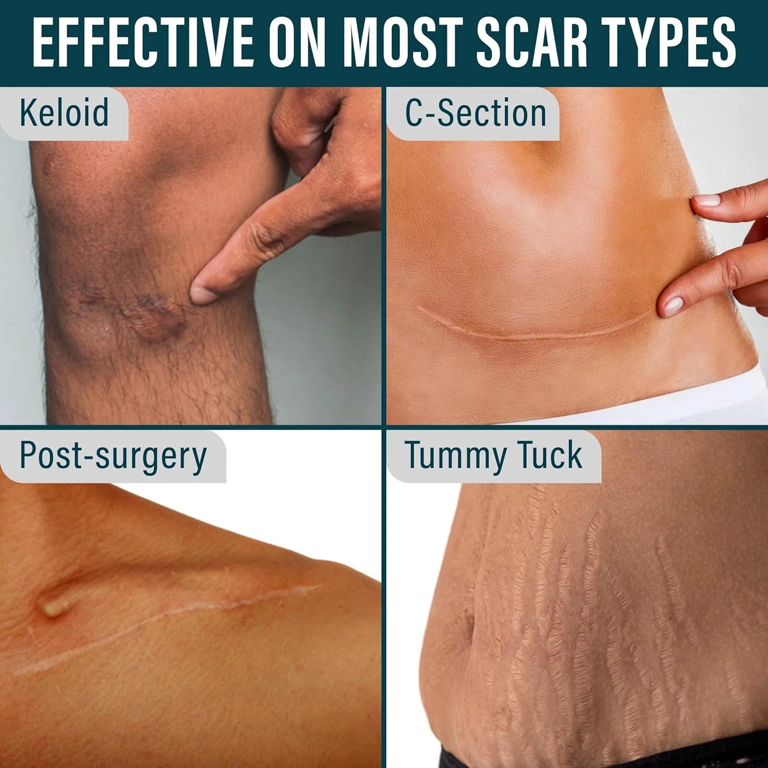 Scar Tape